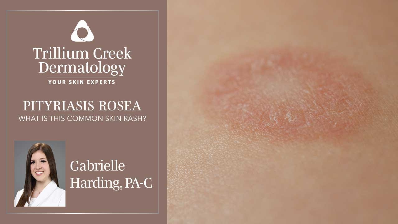 What is Pityriasis Rosea?