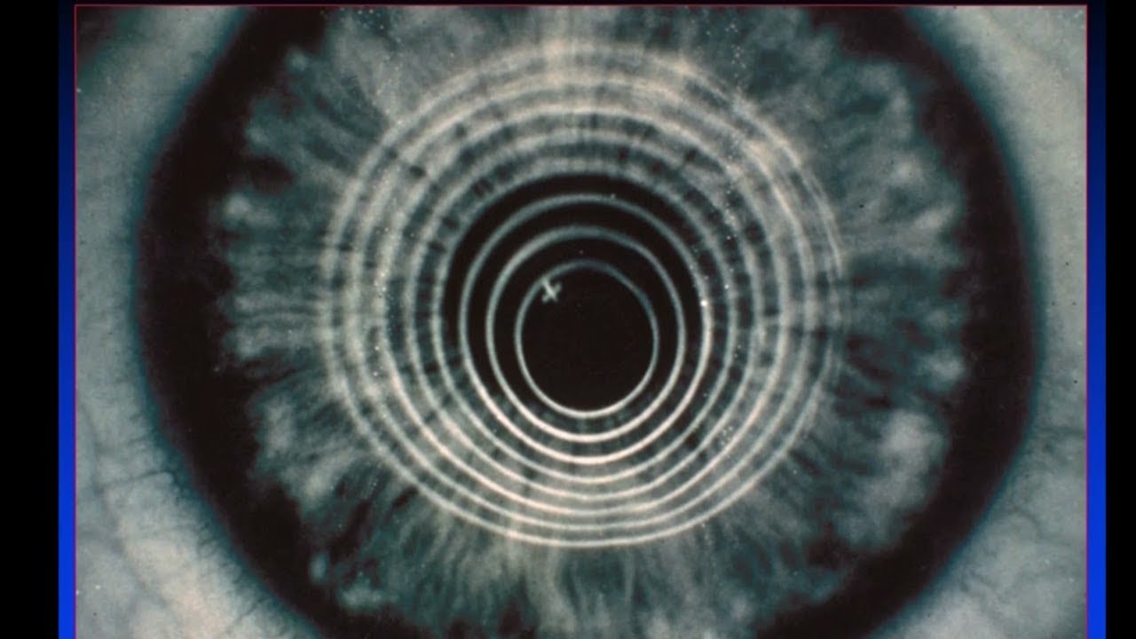Contemporary Keratoconus Management - Crosslinking and Beyond