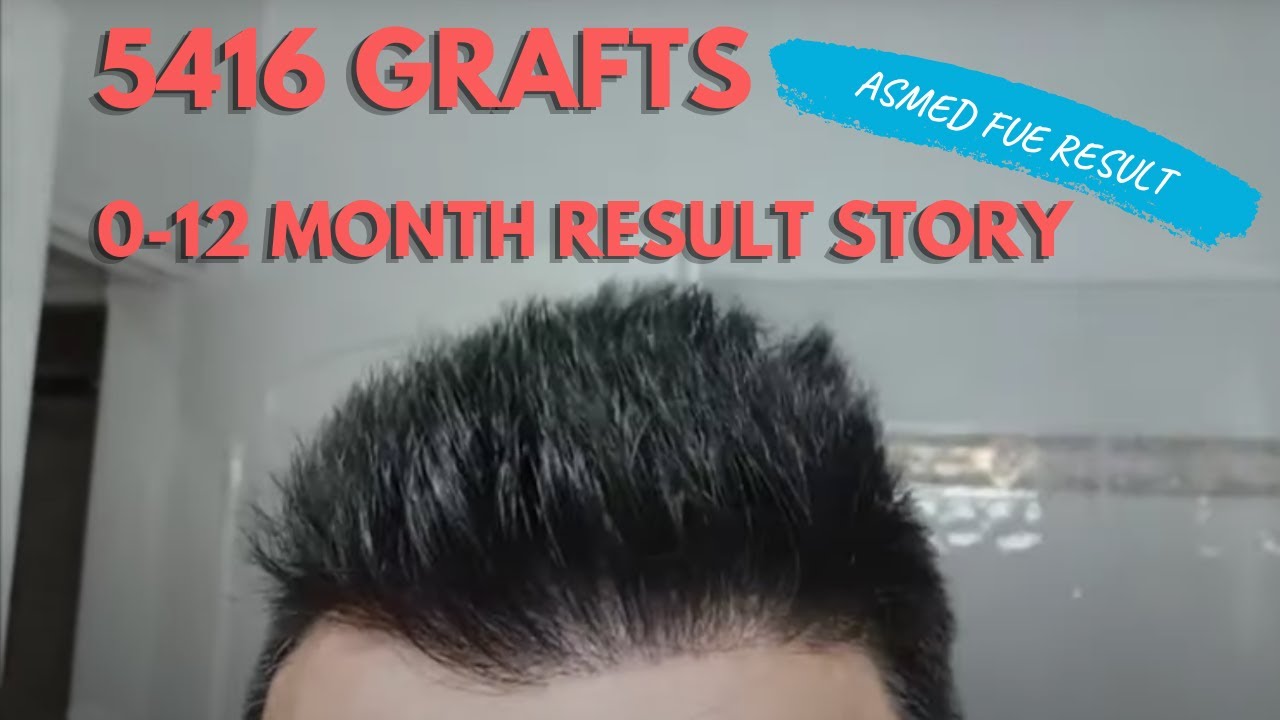 ASMED-Koray Erdoğan(0-12 months) Hair Transplant Result 5146 grafts FUE