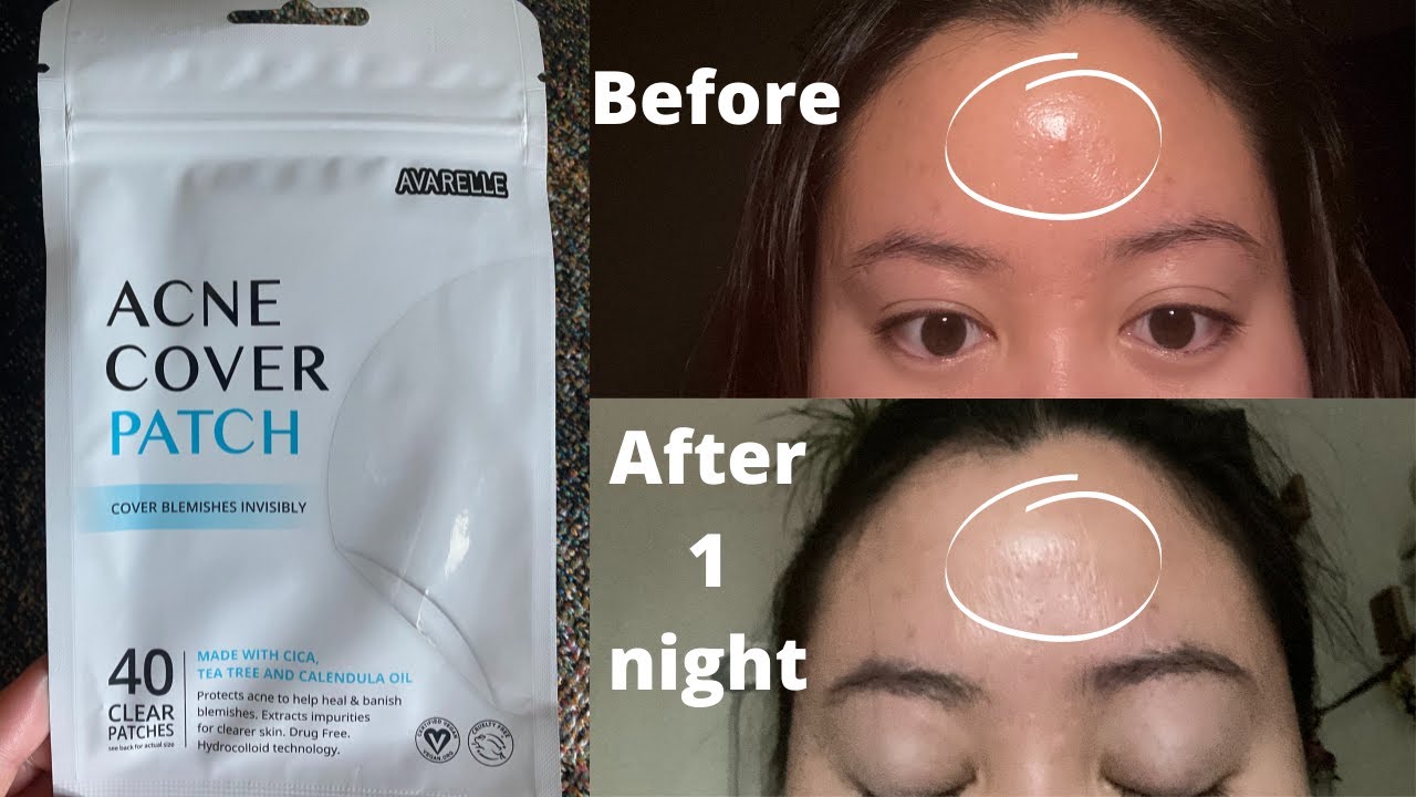 The best pimple patch on Amazon! Avarelle Acne Patches Review