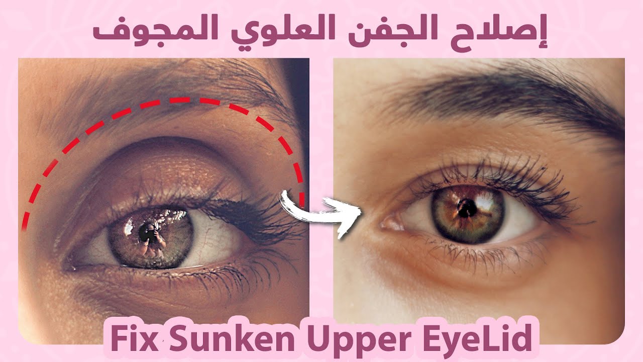 Sunken Eyes | Naturally Fix Sunken Upper Eyelids |  كيفية إصلاح الجفن العلوي الغائر بطريقة طبيعية