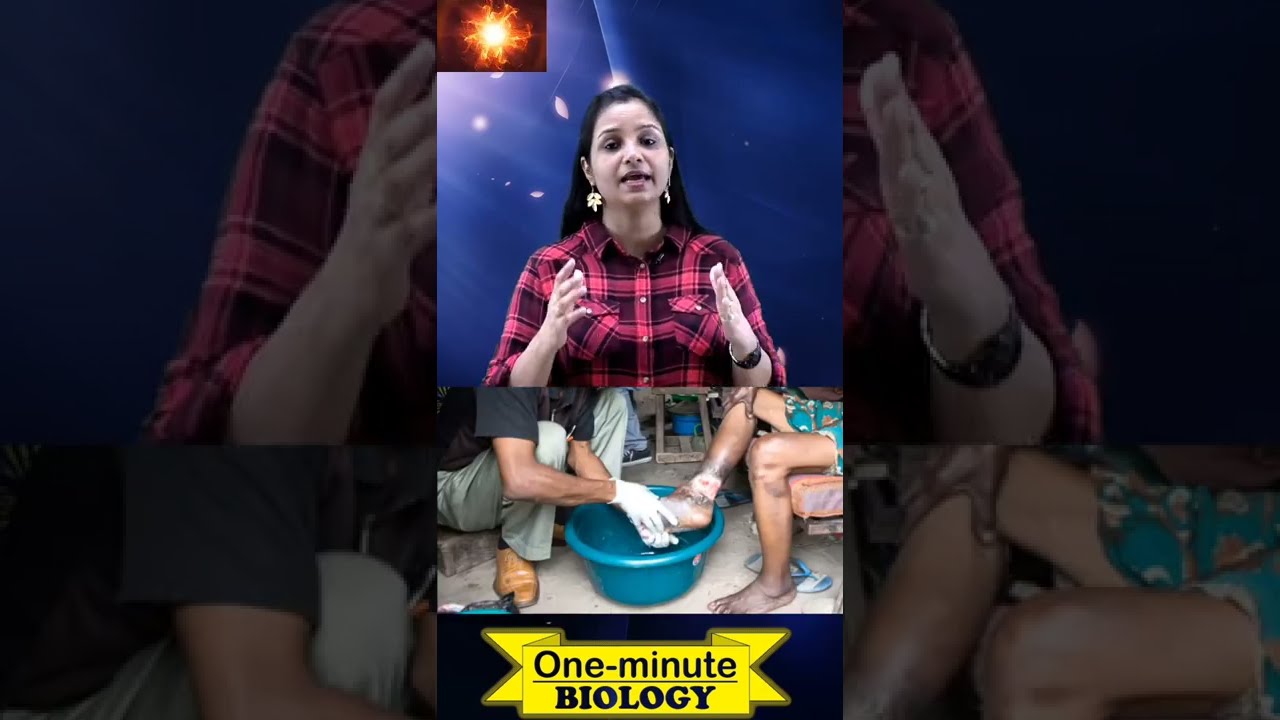 Filariasis | हाथीपाँव | Elephantiasis | Class 12 Biology | shorts |One Minute Biology
