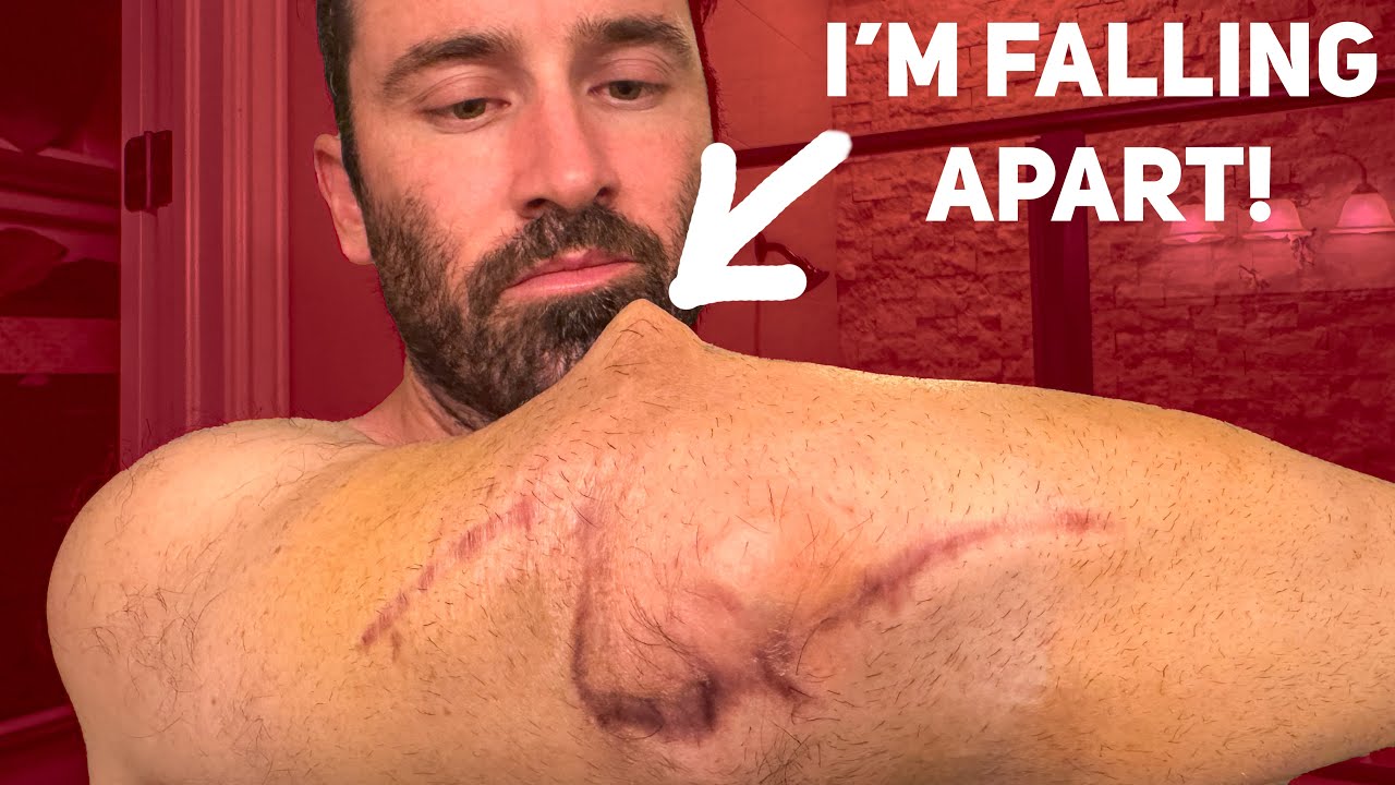 The Surgery to Save My Arm (My Toughest Recovery Yet)