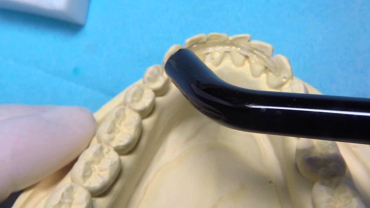 Quartz Splint Periodontal Fiber Reinforced Composite Splinting