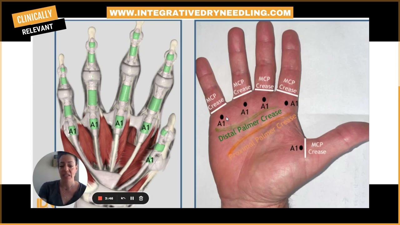 How to Treat Trigger Finger with Dry Needling: Expert Advice from a Certified Hand Therapist