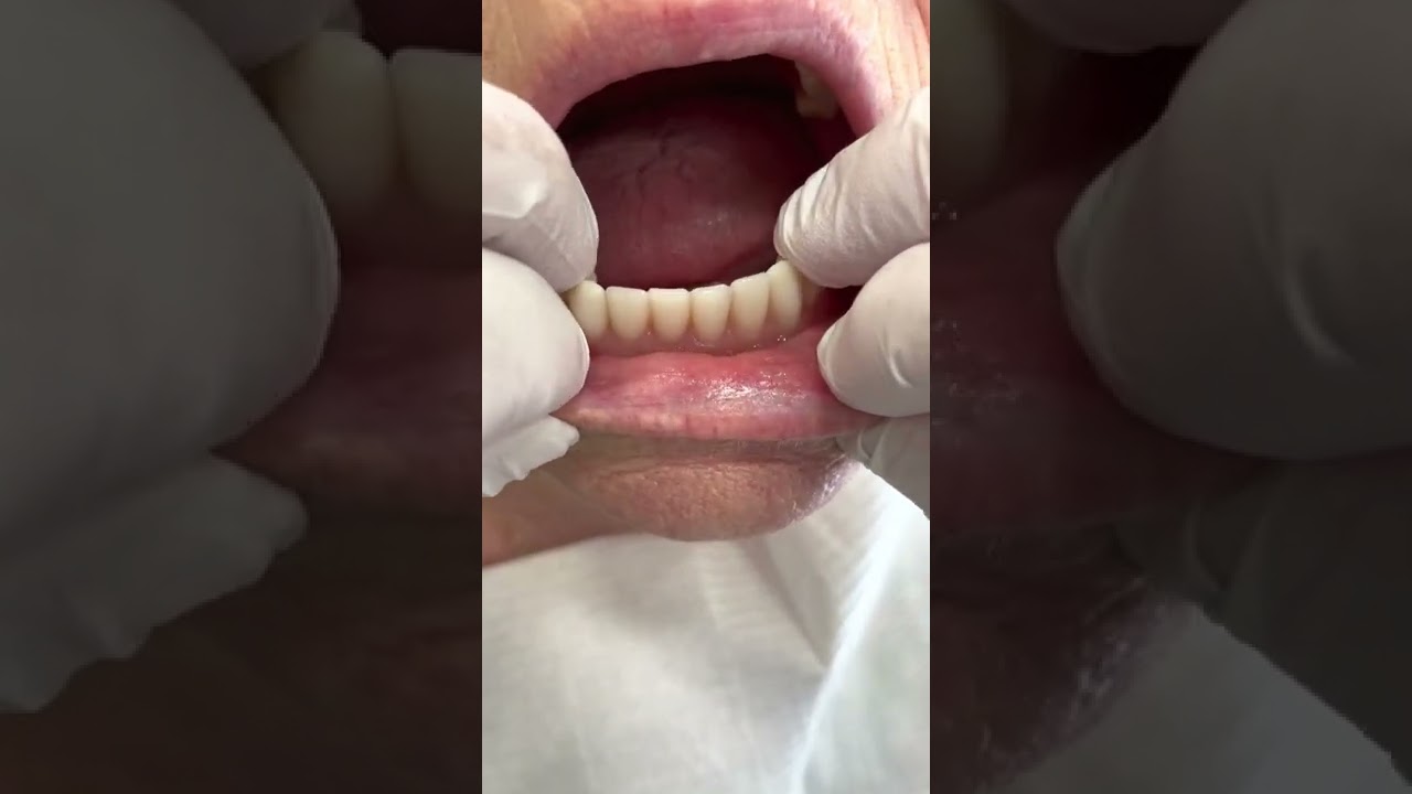 Unstable Complete lower Dentues