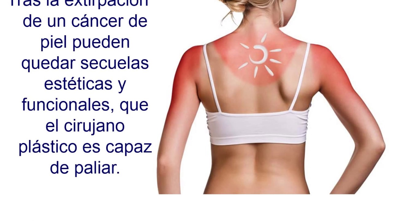 Reconstrucci&oacute;n tras c&aacute;ncer de piel