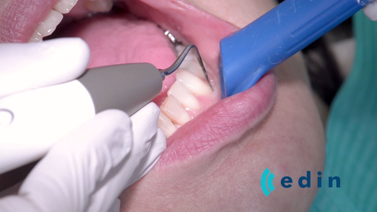 Ultrasoon reinigen bij parodontitis - Edin Dental Academy