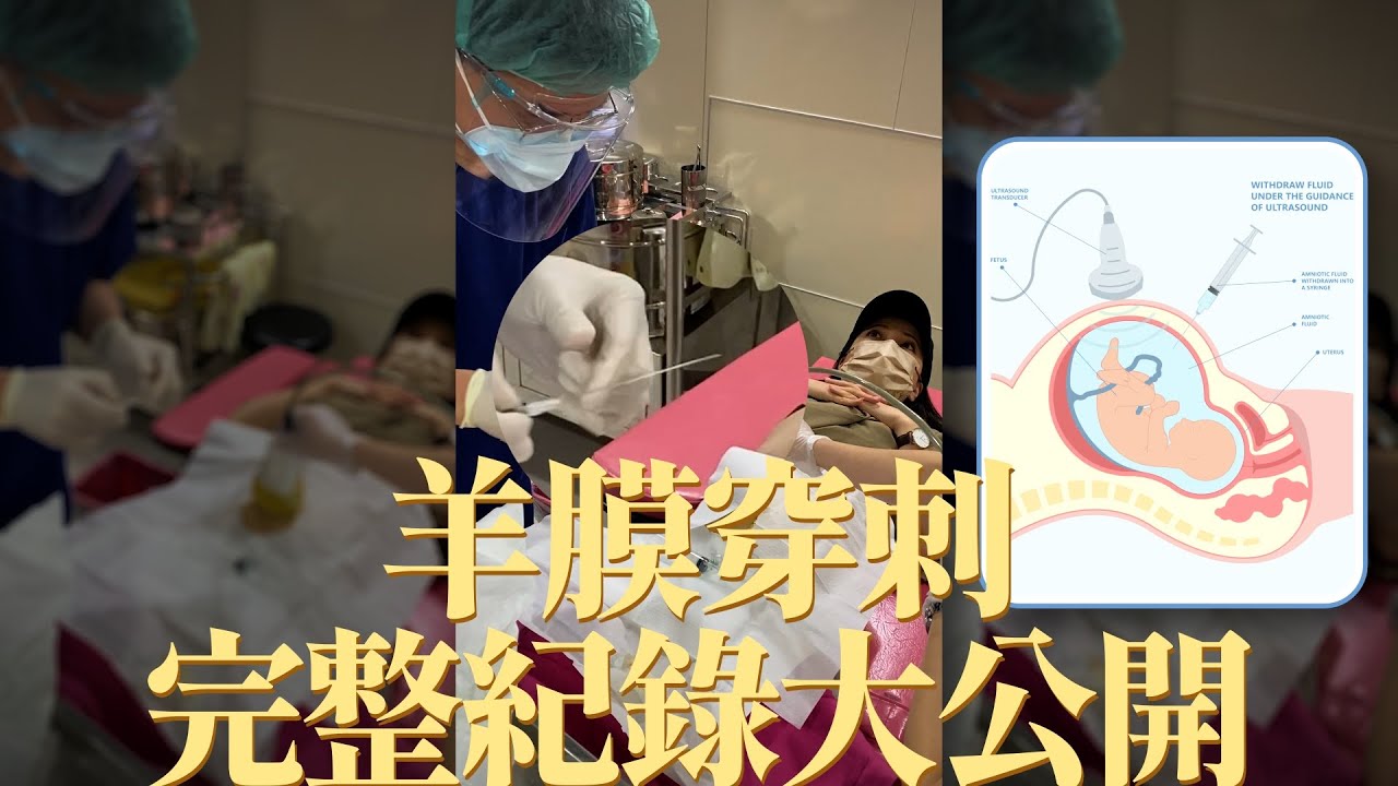 【玉兔娘娘】羊膜穿刺完整過程全紀錄大公開！其實沒有你想像中的可怕。