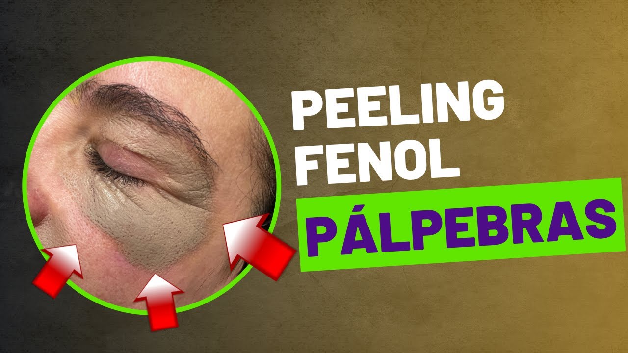 Peeling de fenol para rejuvenescimento das pálpebras!!