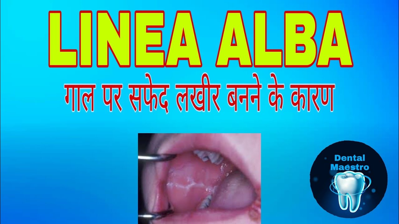 Linea Alba | white line on cheek | Dental Maestro | Dr.Jyoti Agarwal
