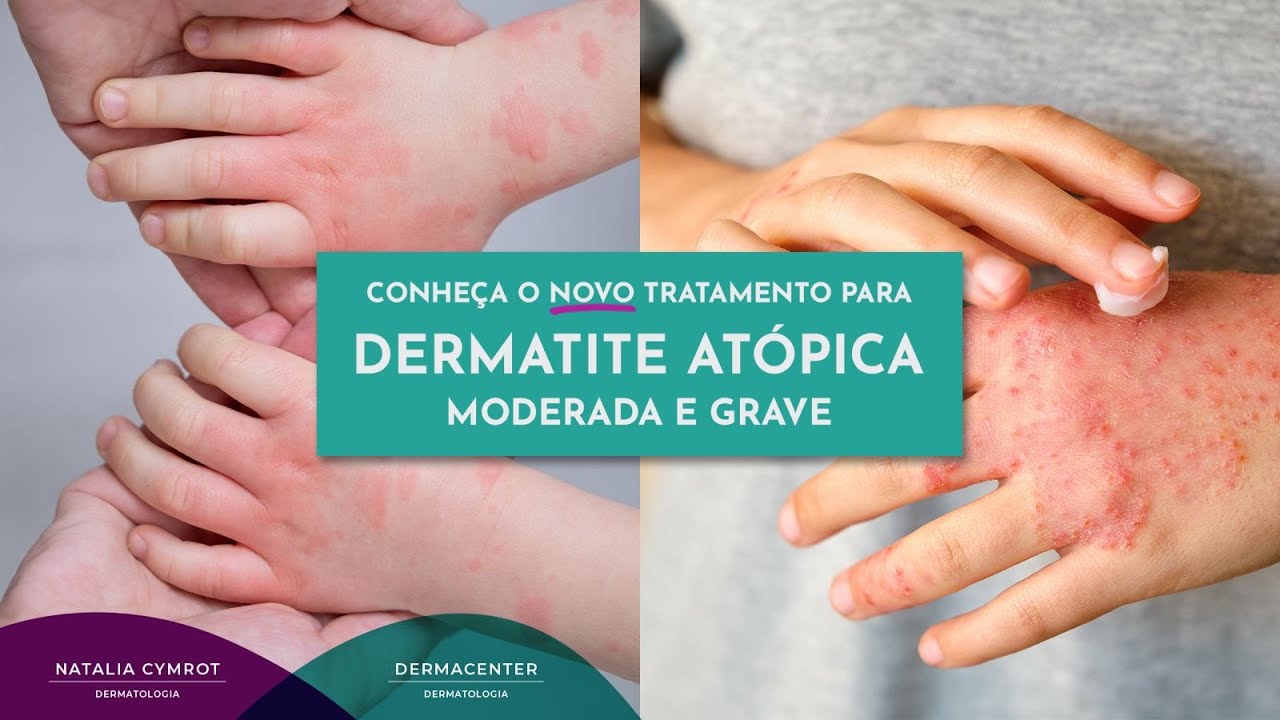 Conheça o novo tratamento para dermatite atópica moderada e grave | Dra. Natalia Cymrot CRM 84332