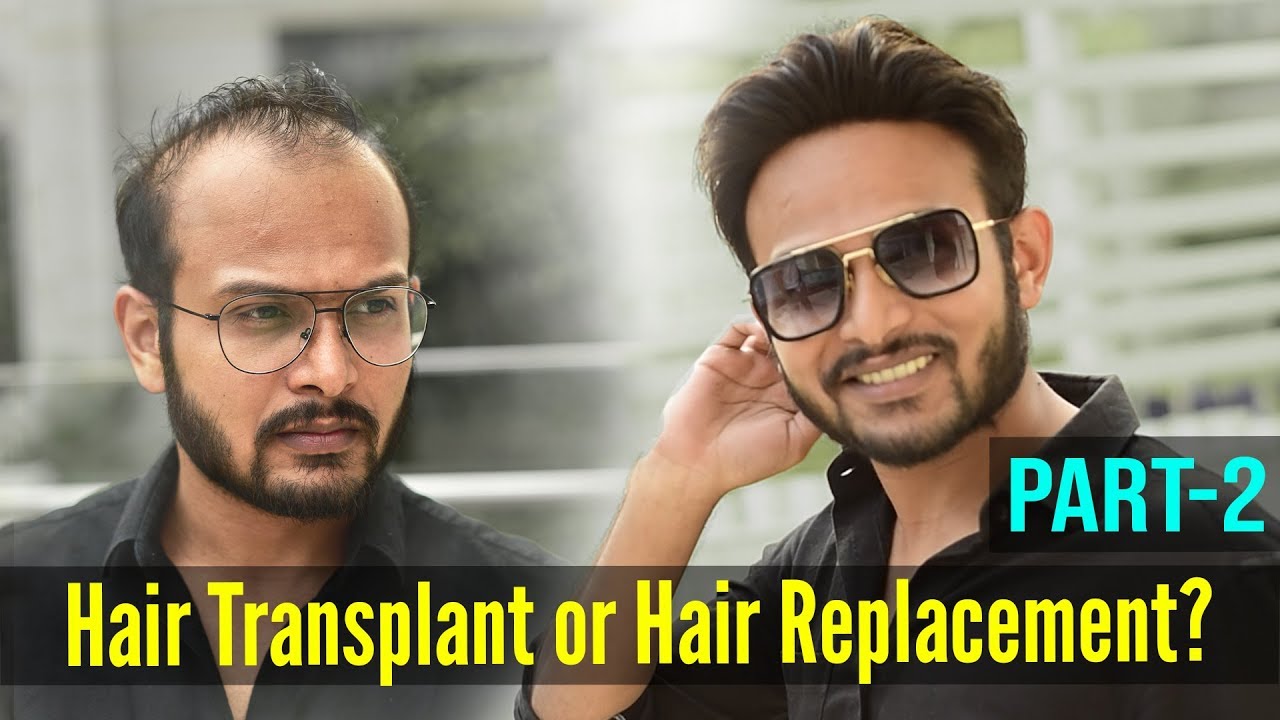 Watch This Before Going for Hair Transplant | Hair Replacement Or Hair Transplant Which is Better