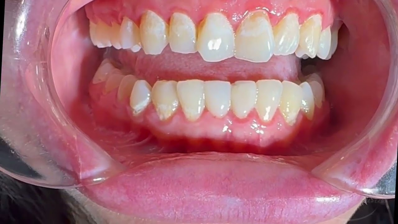 Healthy Gums. Stunning Smile. ✨ Full Smile Makeover with Porcelain Veneers 