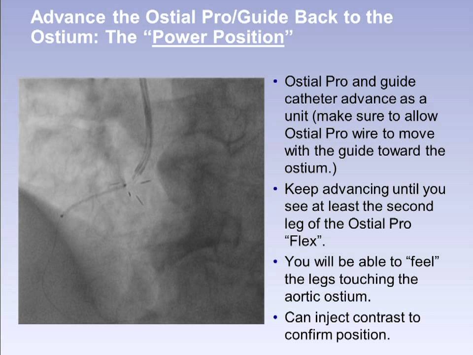 OstialPRO® Stent Positioning System RCA #2