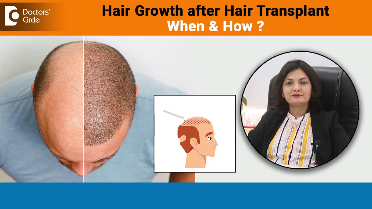 Hair Growth after Hair Transplant Procedure & How fast hair grows - Dr.Aditi Garg | Doctors’ Circle