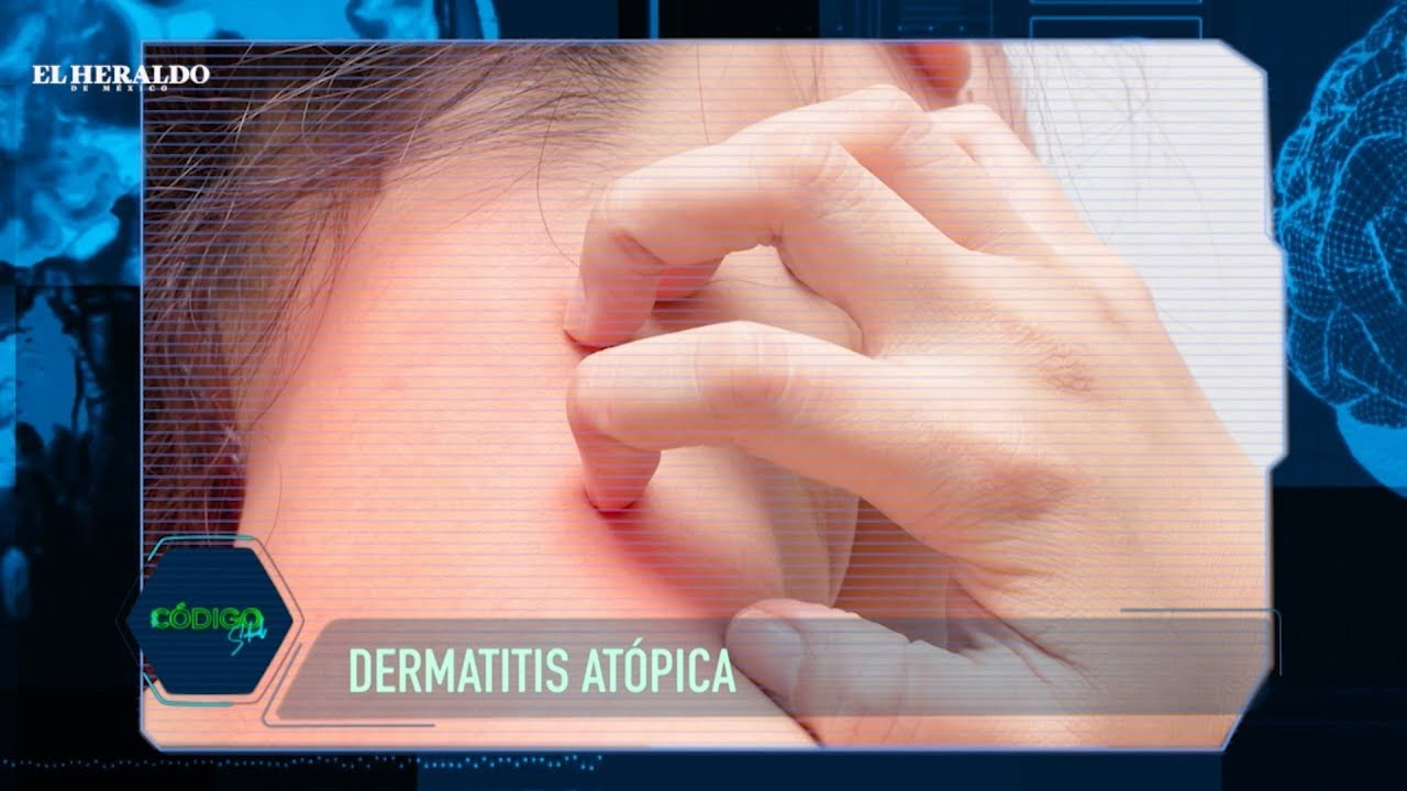 ¿Qué es y cómo tratar una dermatitis atópica?