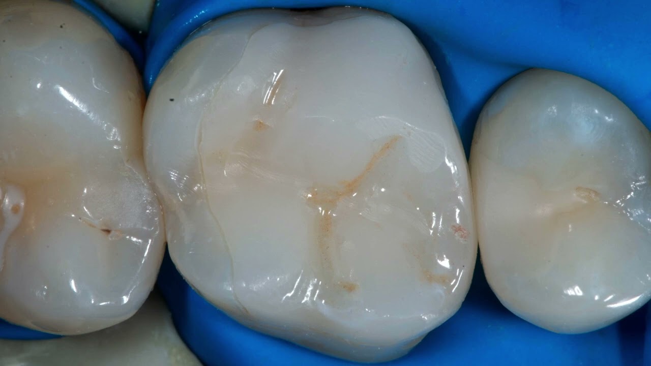 CJ Flexion Twin Blue Dental Microscope - review after 3 years  - fist look at the new CJ Camera