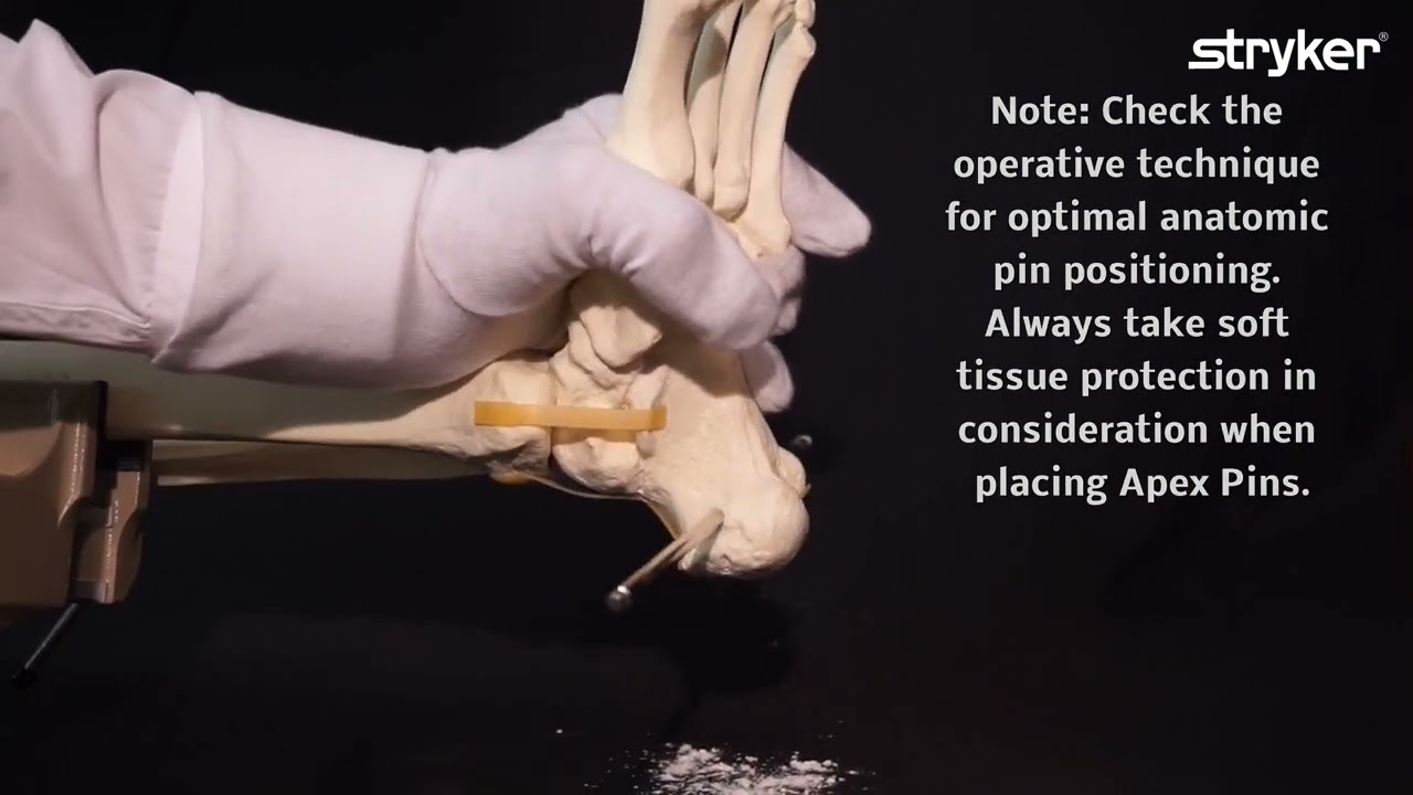 Hoffmann 3 External Fixation System: How to build a Delta Ankle Frame with Hoffmann 3