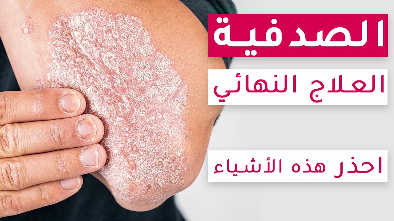 احذر هذه العادات التي تزيد من الصدفية | الاعراض والاسباب | أحدث طرق علاج الصدفية
