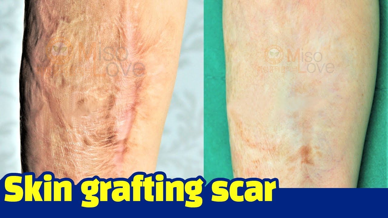 ［Scar clinic in korea］Skin grafting scar treatment