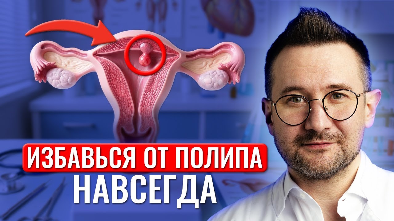 Как ПРАВИЛЬНО вылечить полип в матке? Не дайте себя обмануть