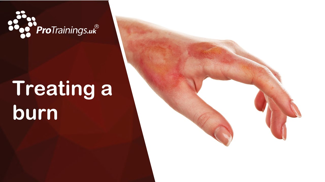 Treating a burn - what is first aid for burns and the types of burns and burns kits