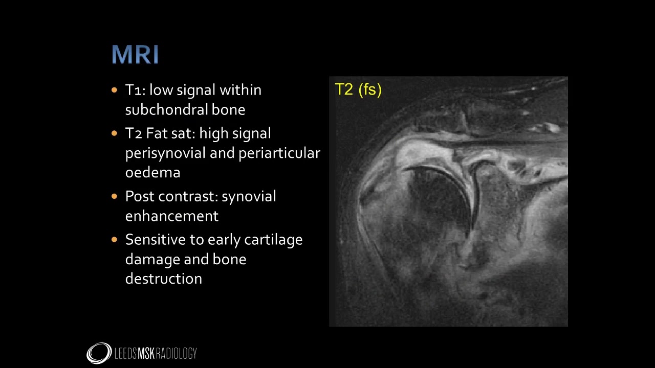 Imaging  findings of Septic arthritis, Tenosynovitis, Bursitis