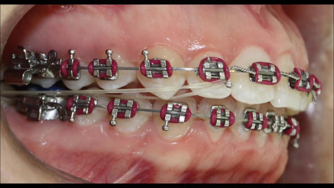 Maloclusión CII dental