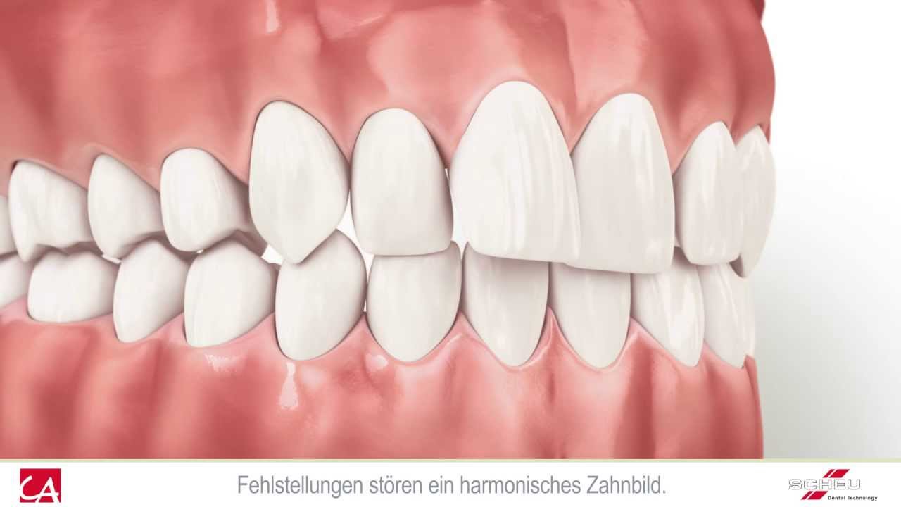 Clear_Agliner_Scheu_Dental