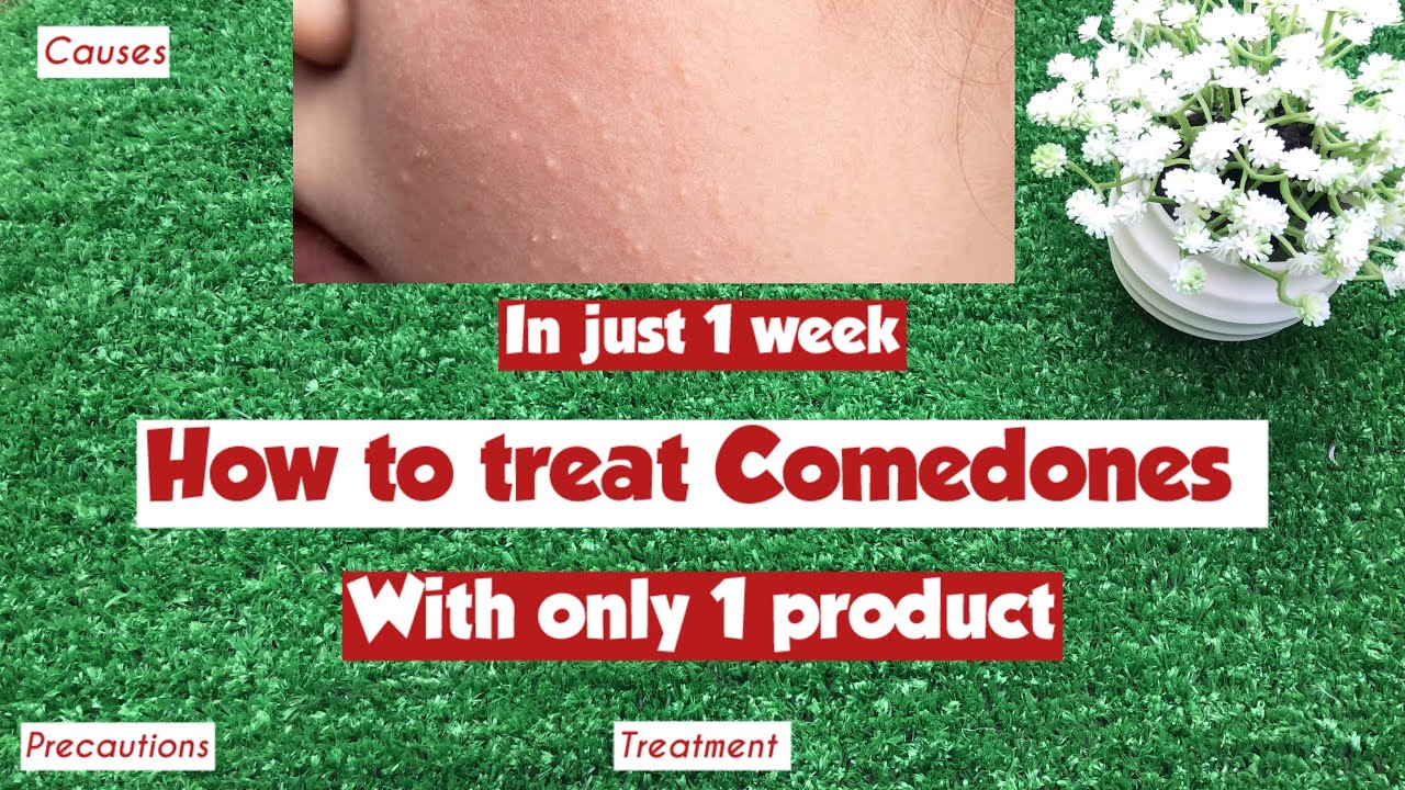 How to treat Closed Comedones in a Week ⁉️| Causes of Comedonal Acne | Esha Chohan