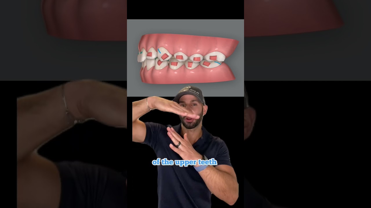 My Invisalign Clincheck smile design mechanics explained. 2023