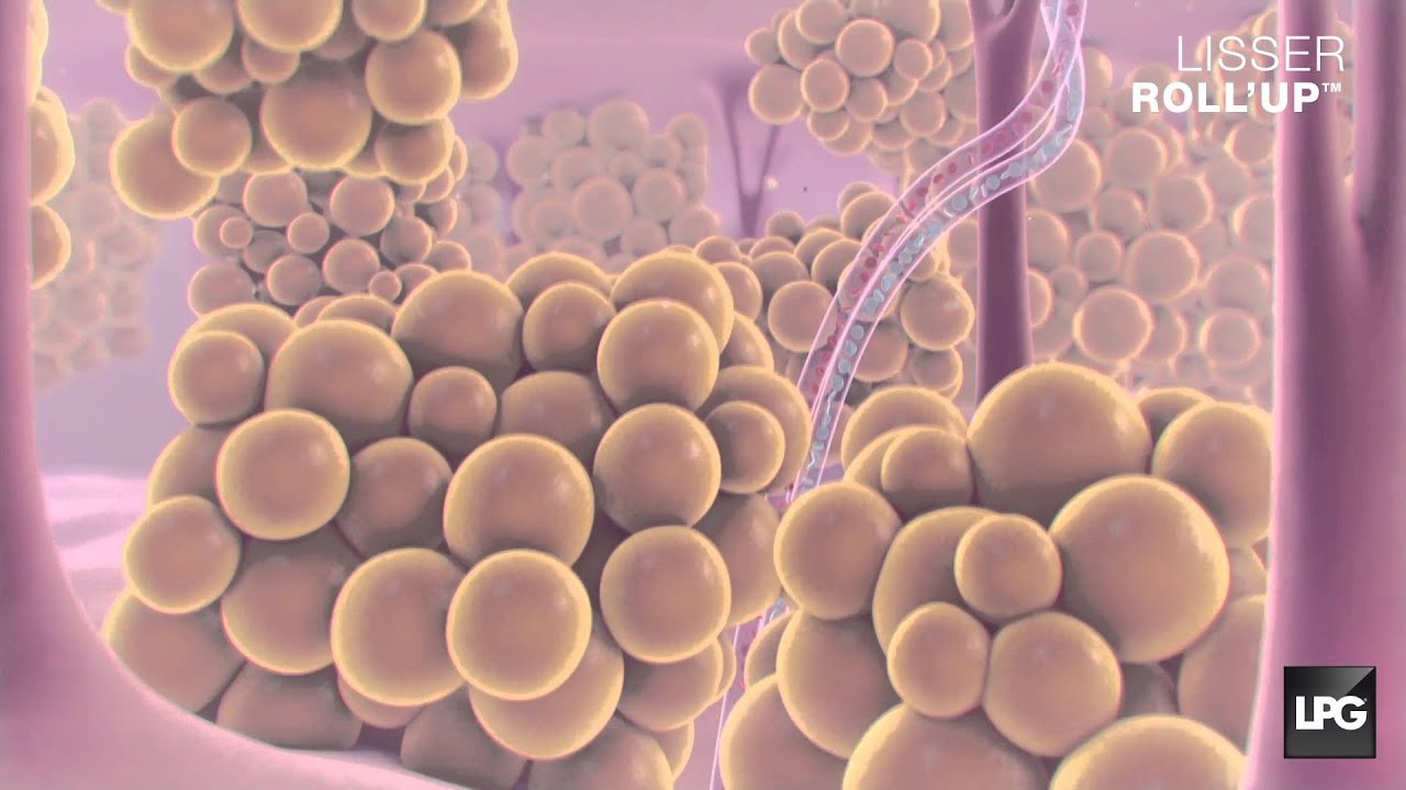endermologie® Corps