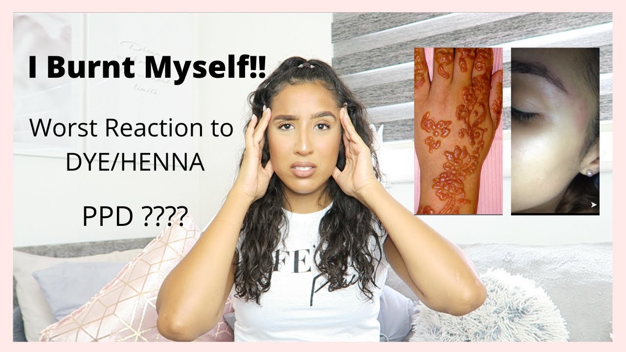 STORY TIME, I Had An Allergic Reaction To Black Henna And Hair Dye!!