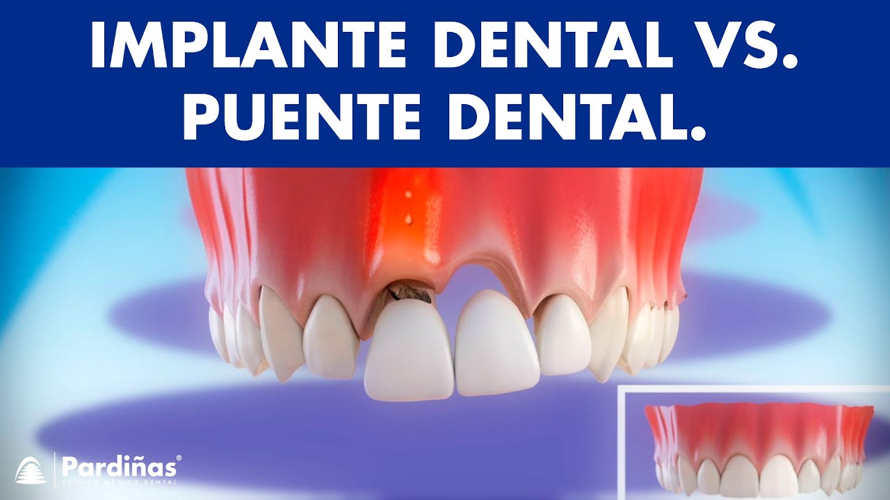 Implante dental VS Puente dental fijo sobre diente natural  - ¿Cuál es mejor? ©