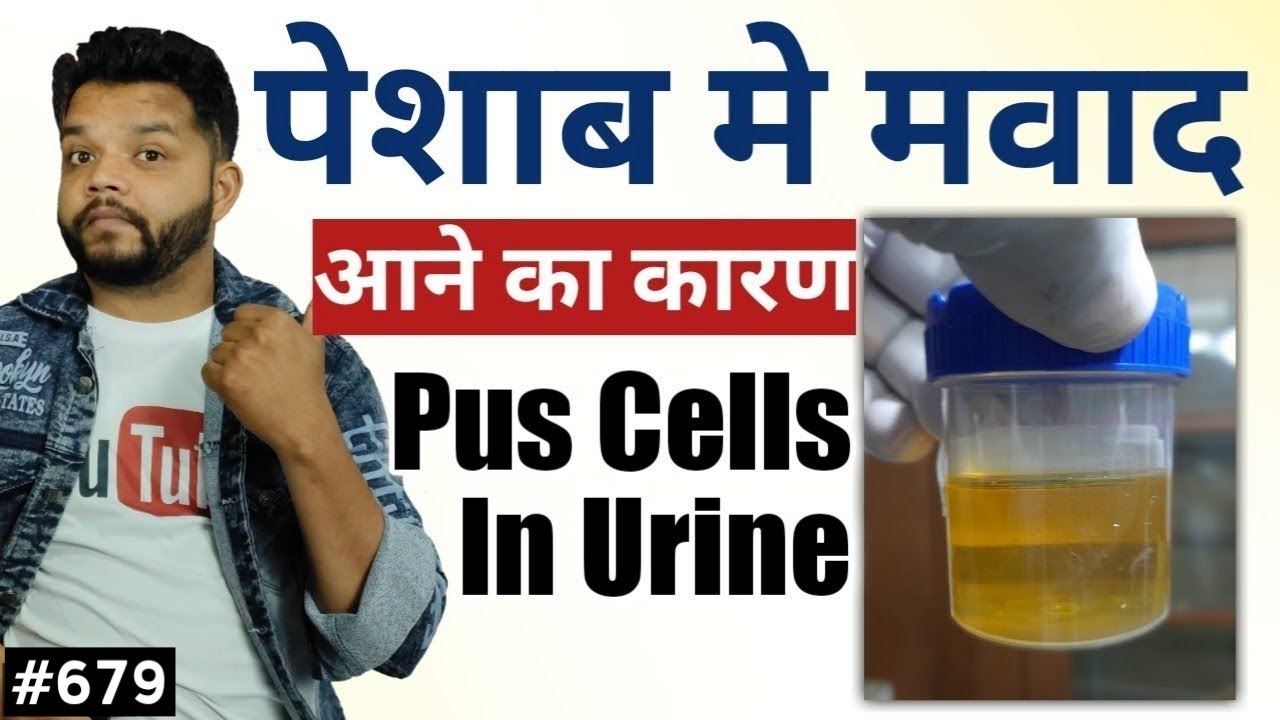 पेशाब में मवाद क्यों आता है / Pus Cell In Urine Explained In Hindi