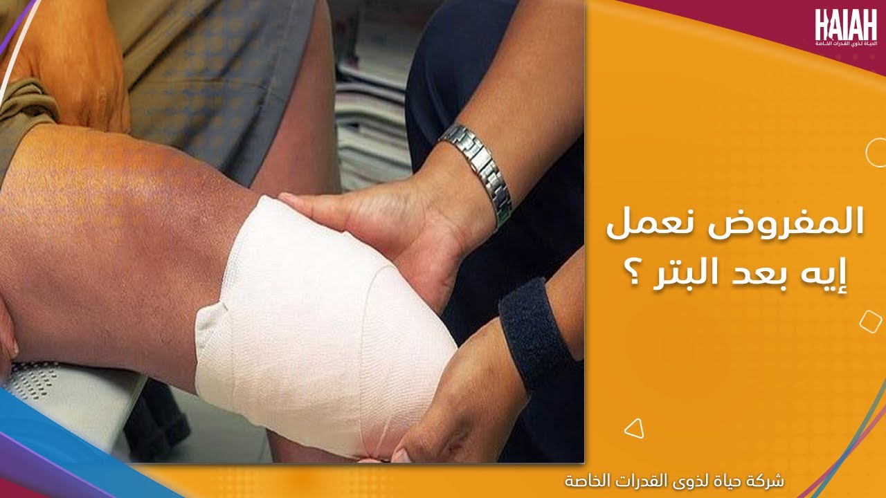 ارشادات مهمة بعد عملية البتر - الحياة لذوي القدرات الخاصة