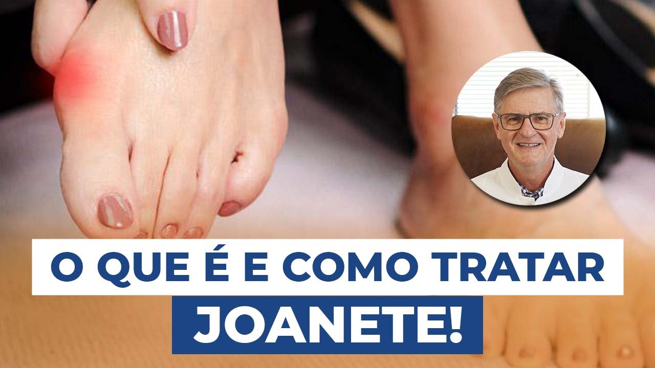 O que é Joanete? (Sintomas e Tratamentos)