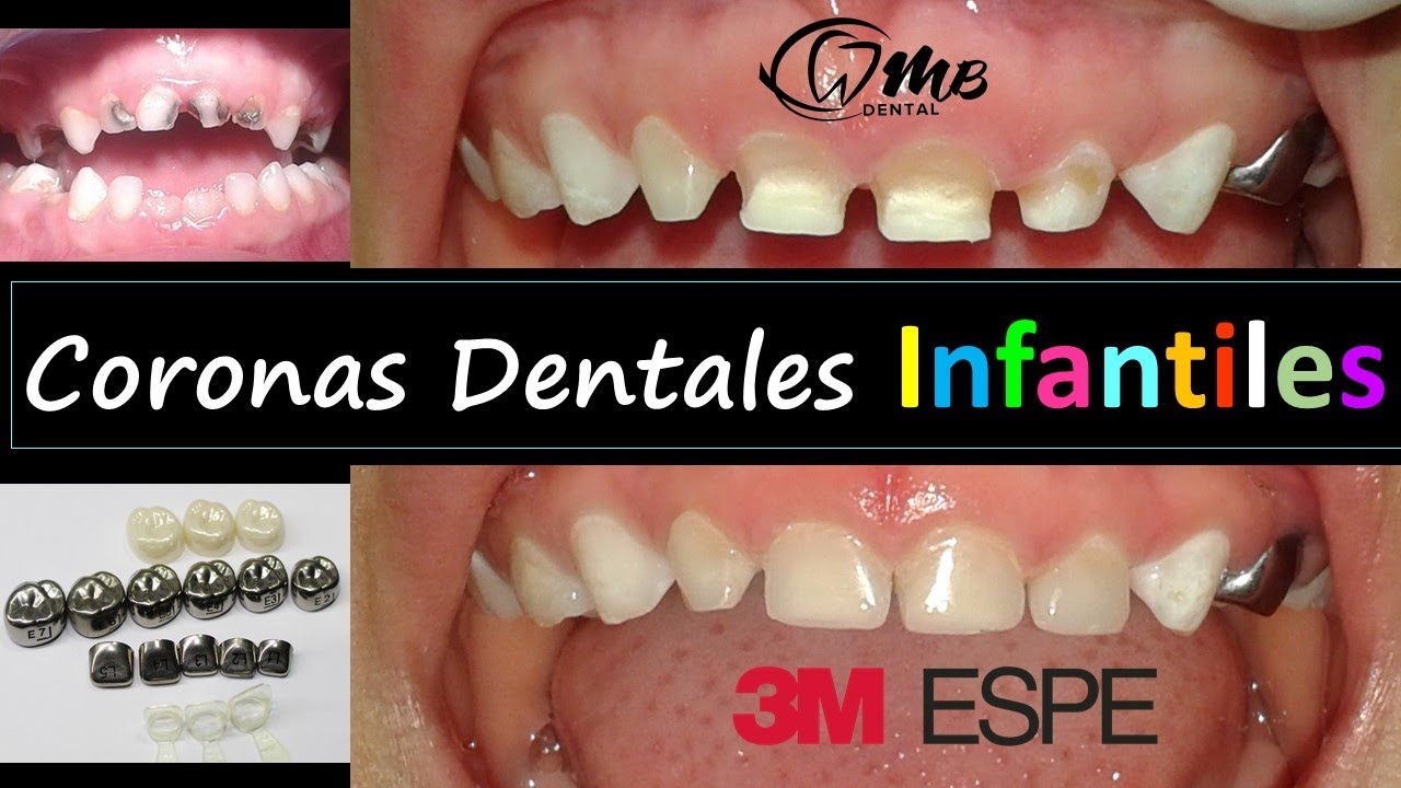 Coronas Dentales INFANTILES. Odontopediatría.