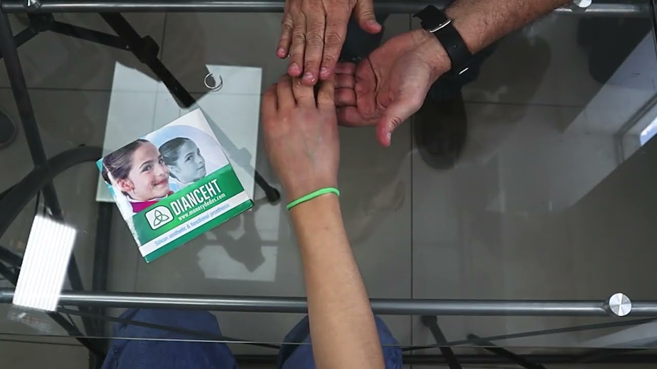 ✨ Presentamos nuestra prótesis hiperrealista para dos dedos