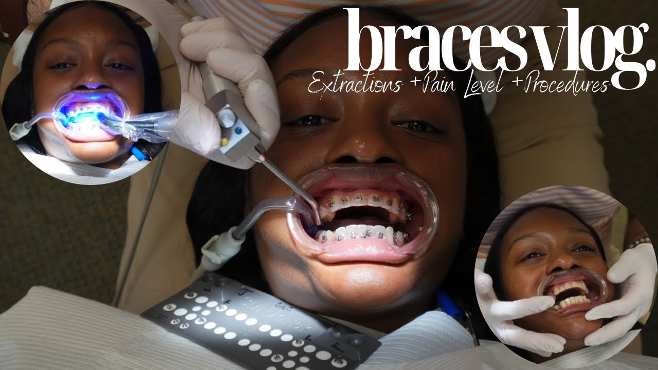 BRACES VLOG| I got braces for the first time! Extractions + Pain Level Updates + What I ate + More