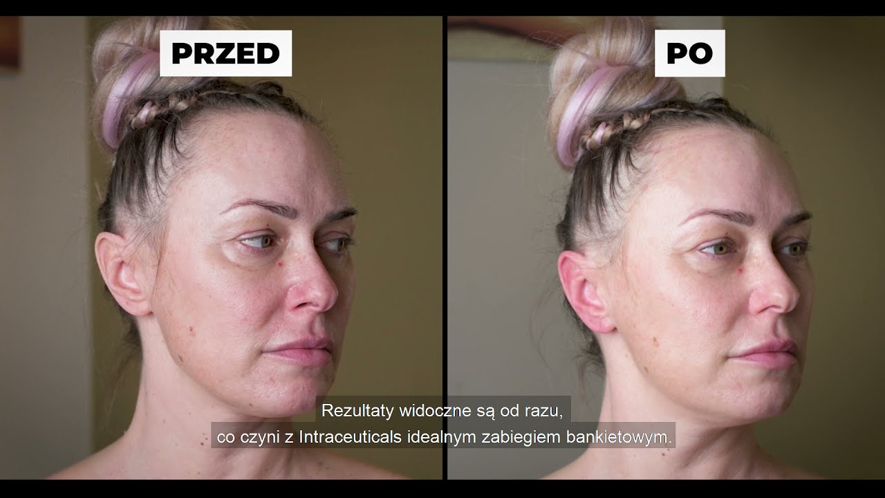 Infuzja tlenowa Intraceuticals - zabieg uwielbiany przez gwiazdy | Salon Sopot