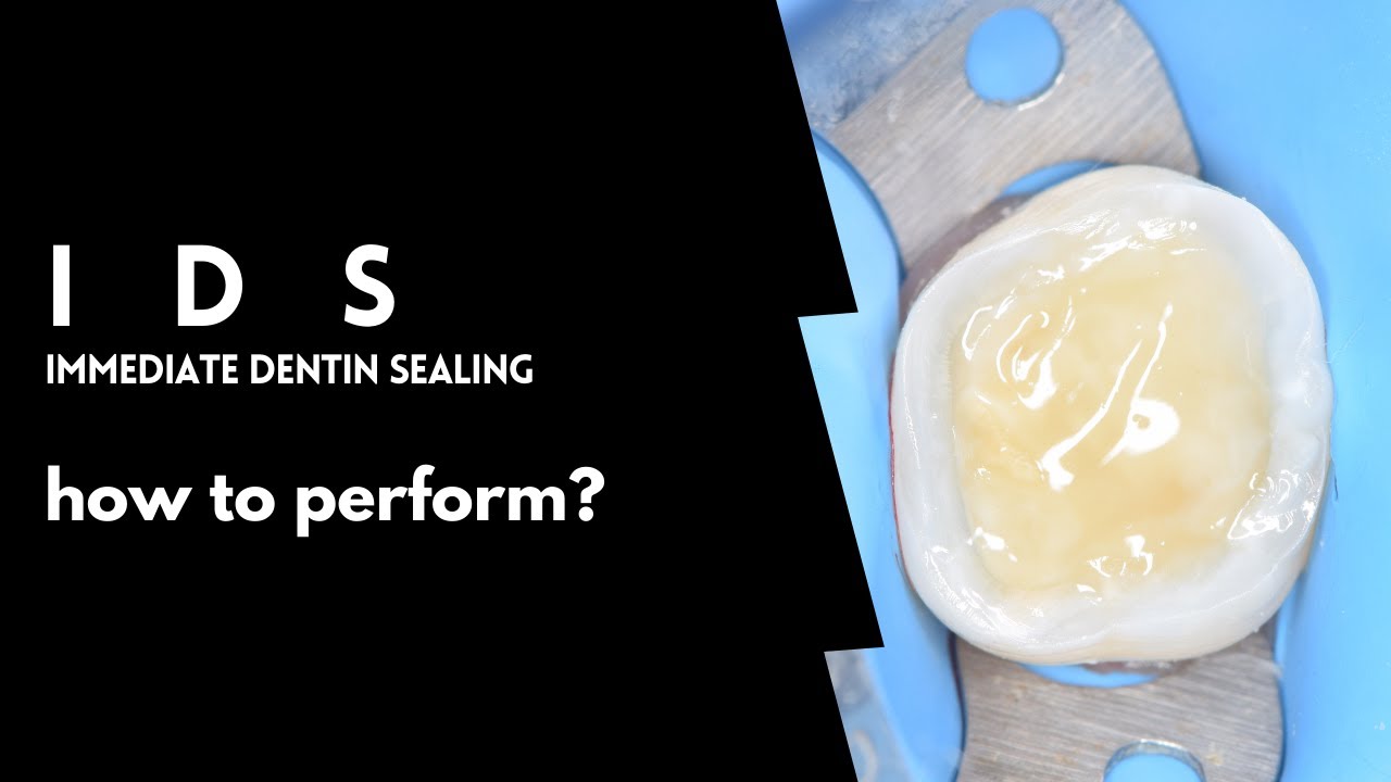 Immediate Dentin sealing | How to perform | Full protocol