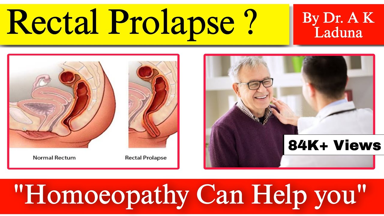 Prolapse of Rectum: How Homeopathy Helps I Clear Guide for Patients & Doctors