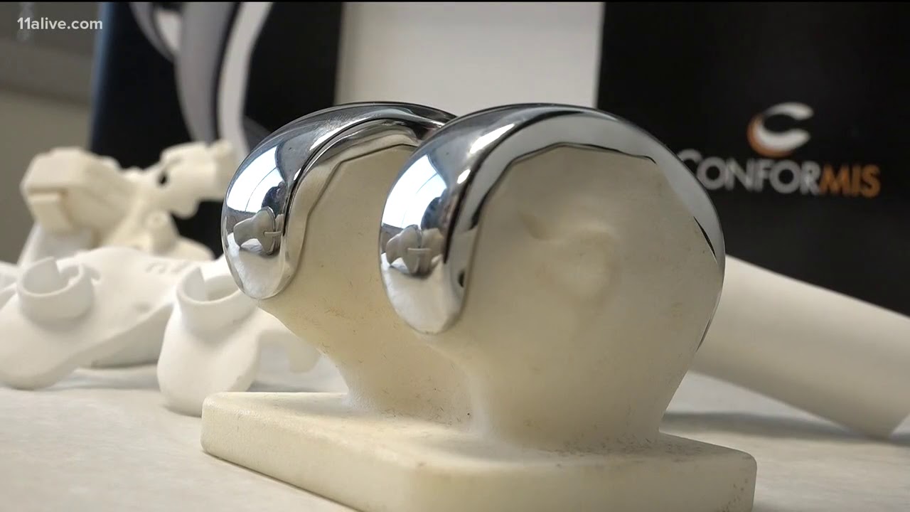 3D printed knee implants create custom