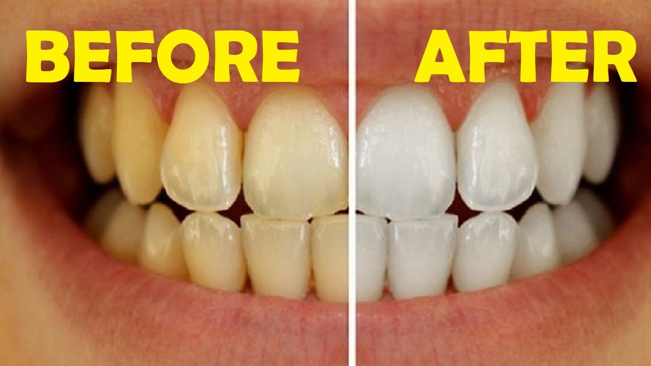how to get rid of yellow teeth naturally in 30 seconds