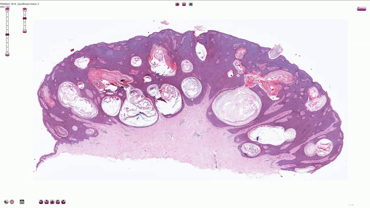 Seborrheic Keratosis (Including Variants) - Histopathology