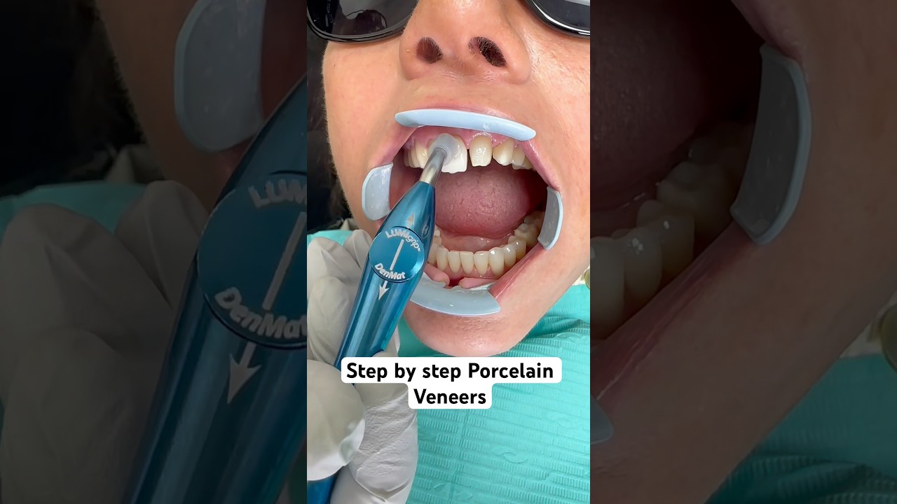 Step by step porcelain veneer makeover ❤️