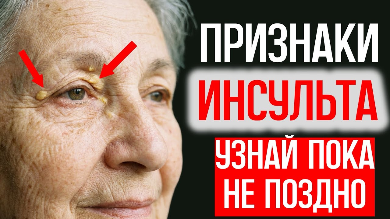 За МЕСЯЦ Тело предупредит!!! 5 Симптомов Скорого Инсульта