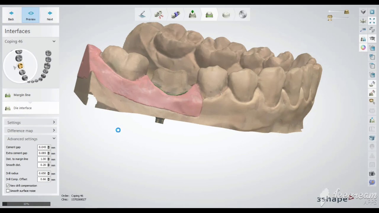 3shape crown design  أ.أسامة حجاوي